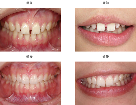 ラミネートベニア：　歯と歯の間に隙間が空いている