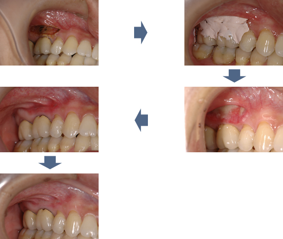 歯科レーザーによる舌小帯の切除