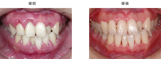 歯周病治療：　歯ぐきが痛い・腫れた・出血がある
