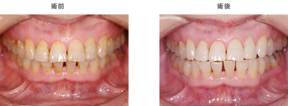 インプラント治療：　歯を1本失ってしまったケース