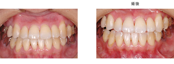 インプラント治療：　歯を1本失ってしまったケース